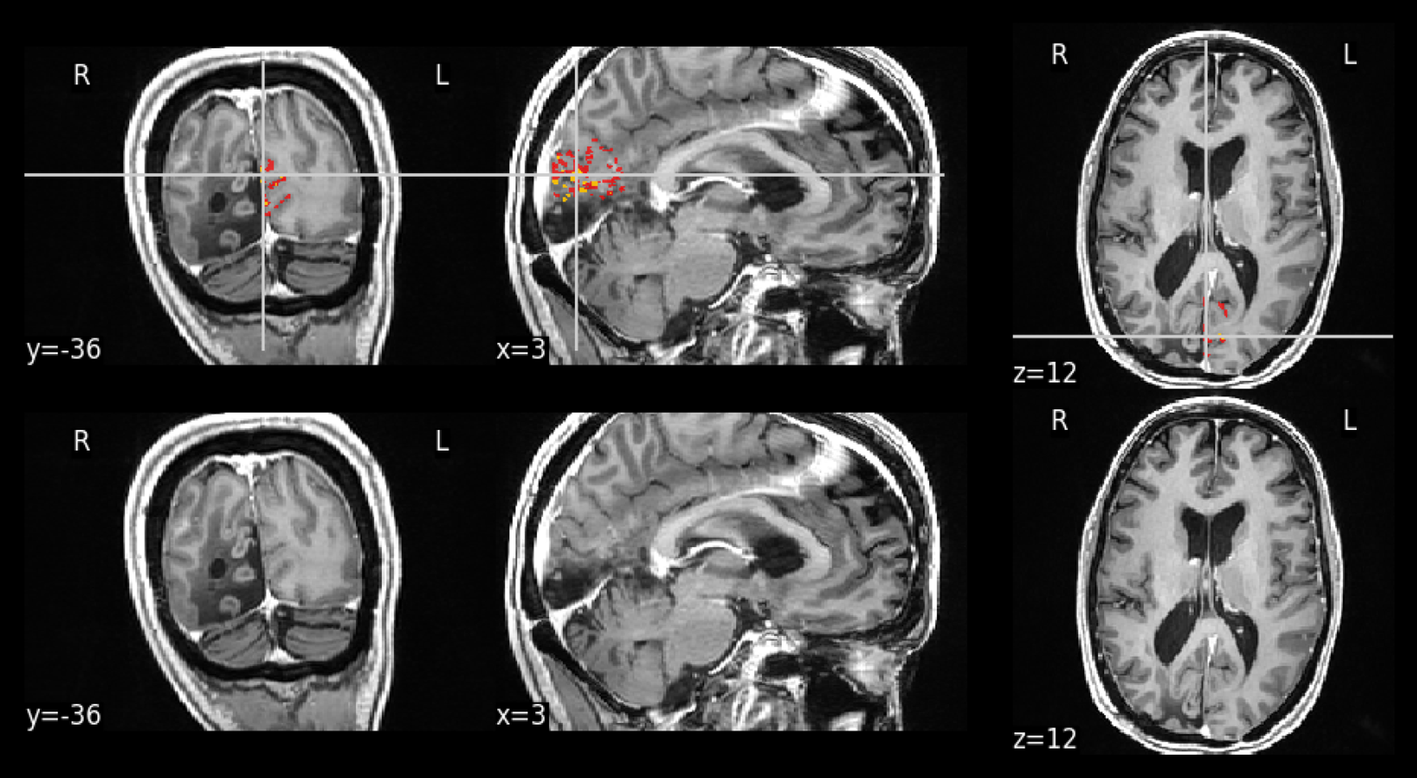 MELD Graph report output MELD Graph output: a candidate focal cortical dysplasia highlighted on coronal, sagittal and axial T1 slices