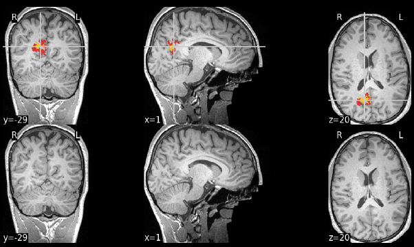 MELD Graph output: a candidate focal cortical dysplasia highlighted on coronal, sagittal and axial T1 slices